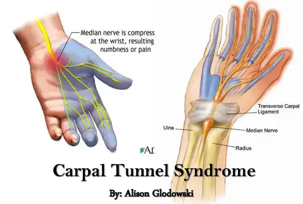 prevent heal carpal