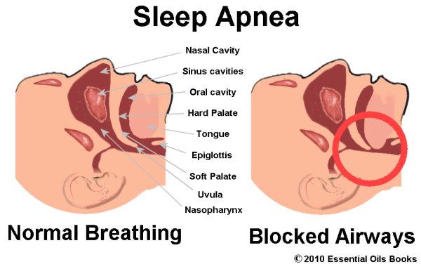 sleep apnea secretly