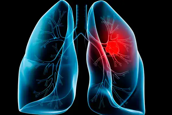 natural remedies lung