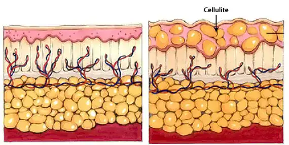 rare case cellulite