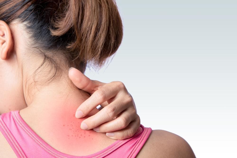 fibromyalgia 038 rashes