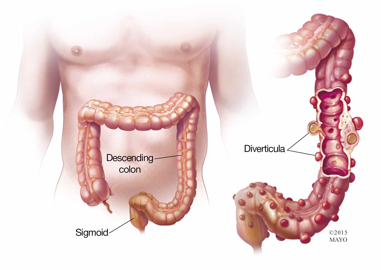 healing diverticulitis naturally