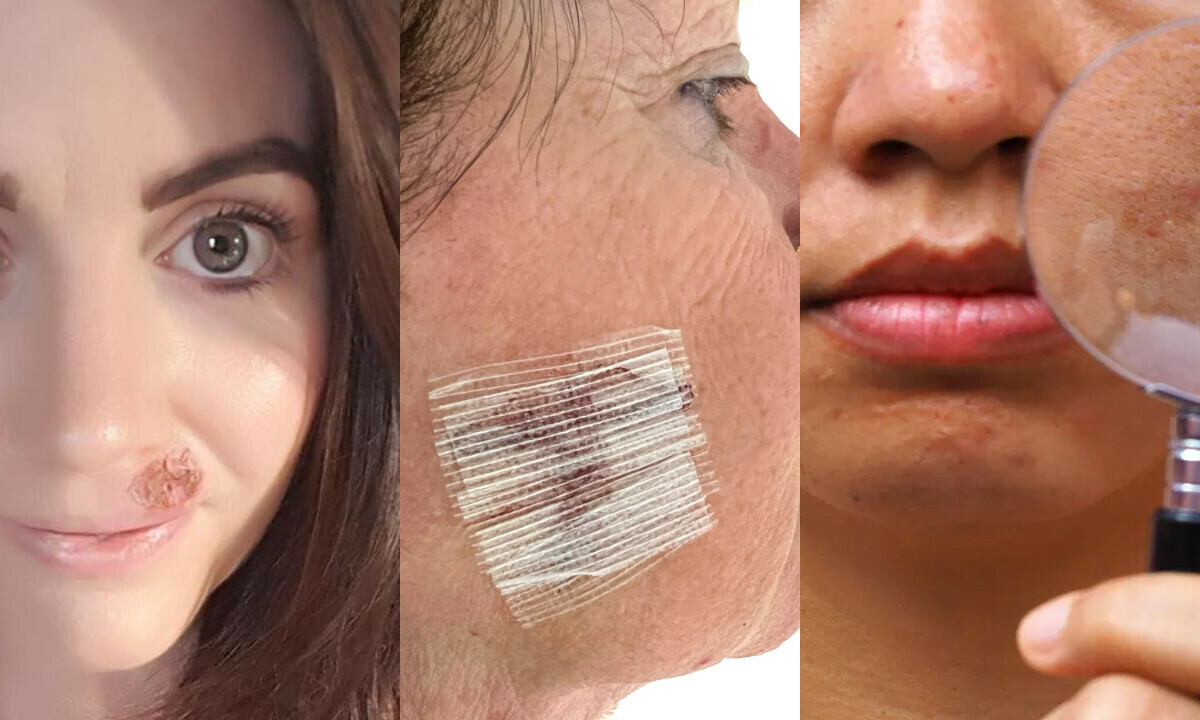 skin cancer warning