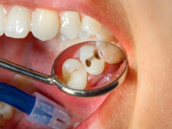 drill free treatment