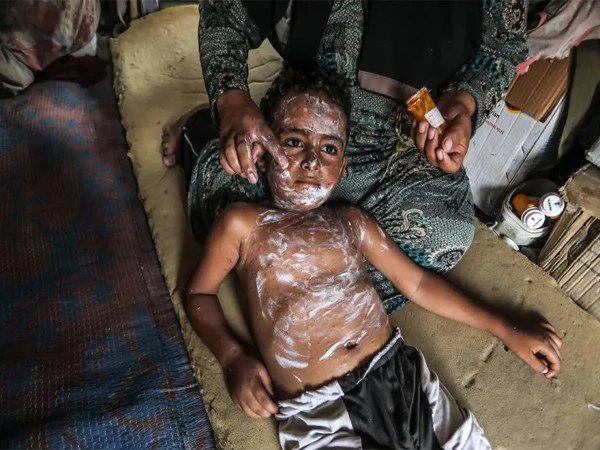 chickenpox cases rise