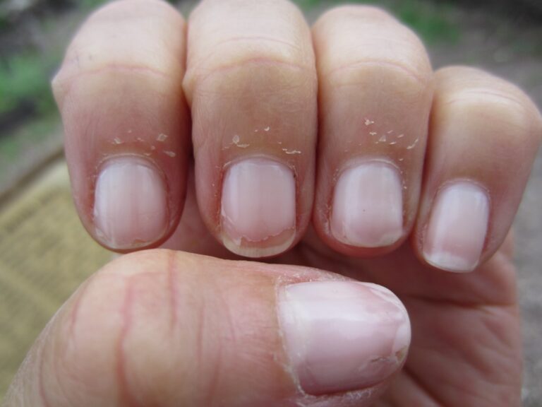 dry skin may