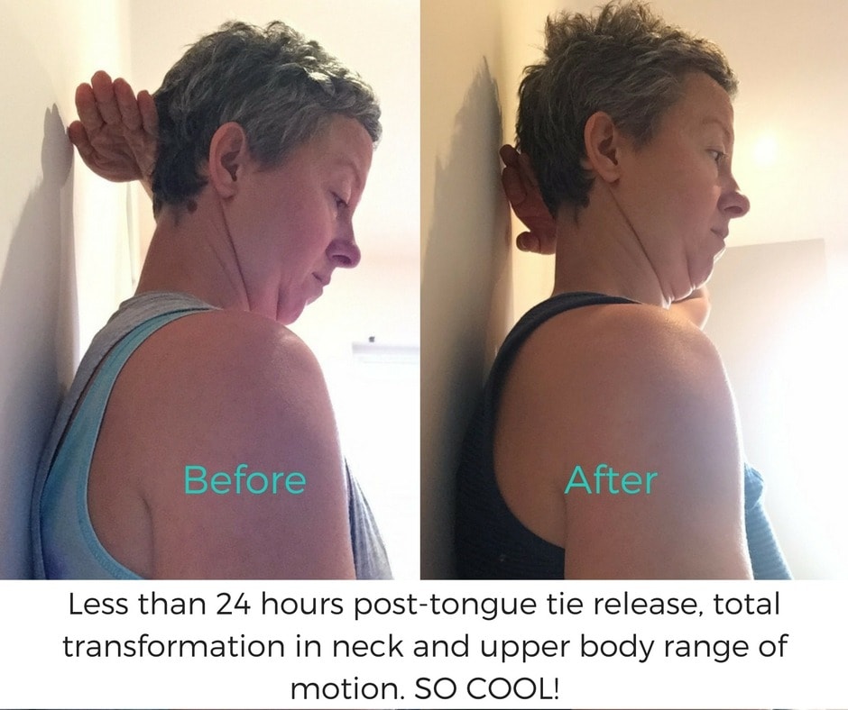 Before and after tongue tie release.jpg