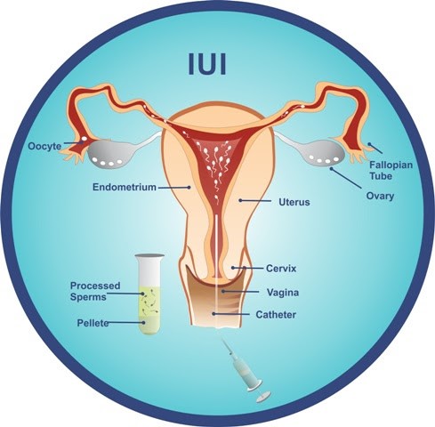 iui.jpg