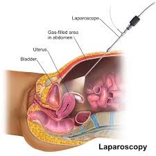laparascopy