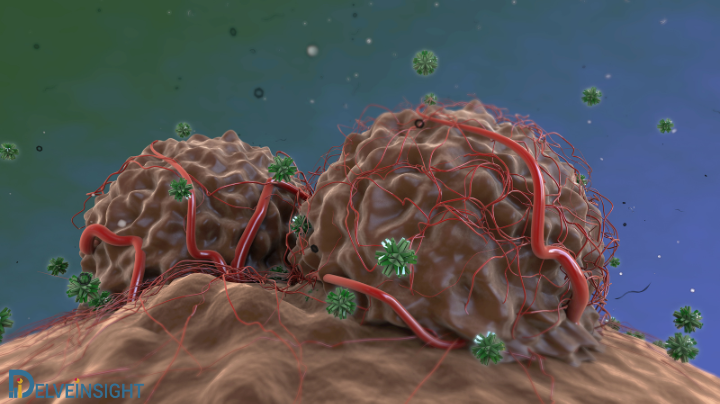 prostate cancer market insights