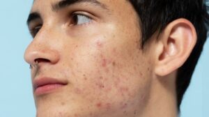 acne 1 300x169.jpg